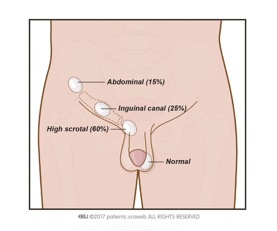 İnmemiş Testis - Kriptorşidizm - Gizli Testis - Tek Testis